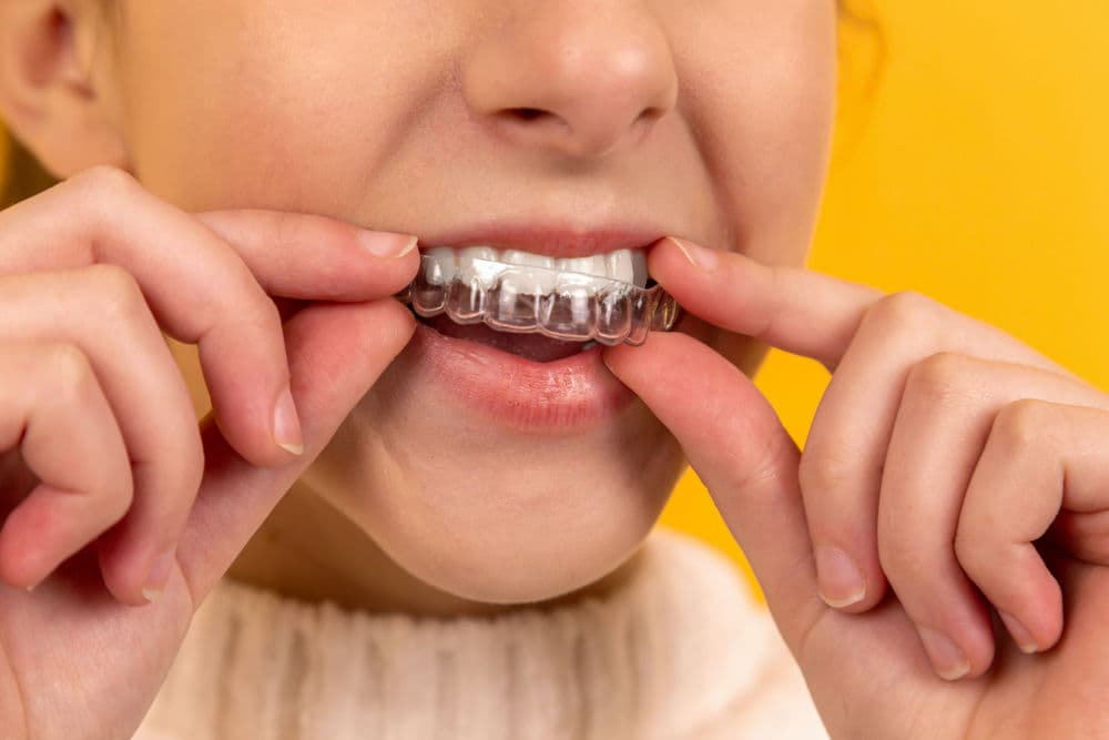 Prozirni aparatić  za zube Invisalign umjesto bravica za zdrav osmijeh